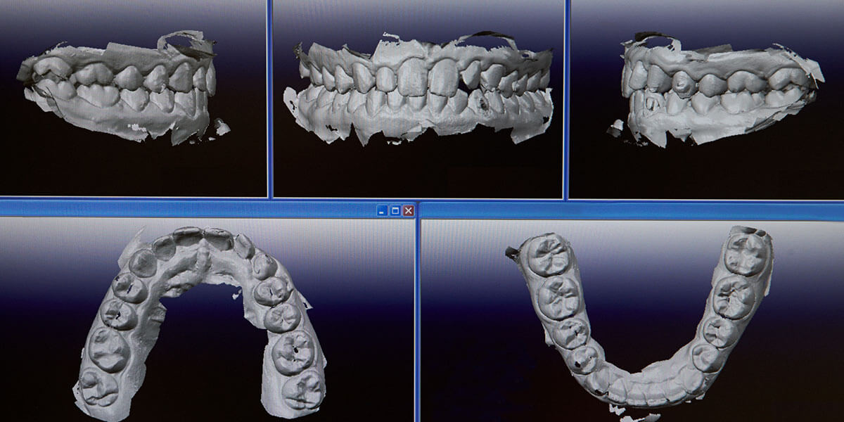 Digital images of upper and lower arch