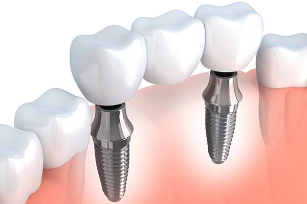 Implant supported bridge illustration